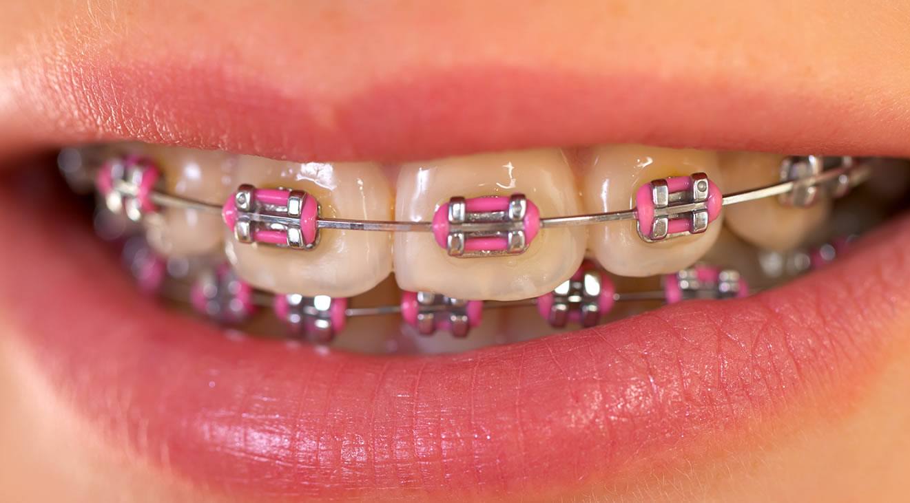 fixed-braces-pink.jpg