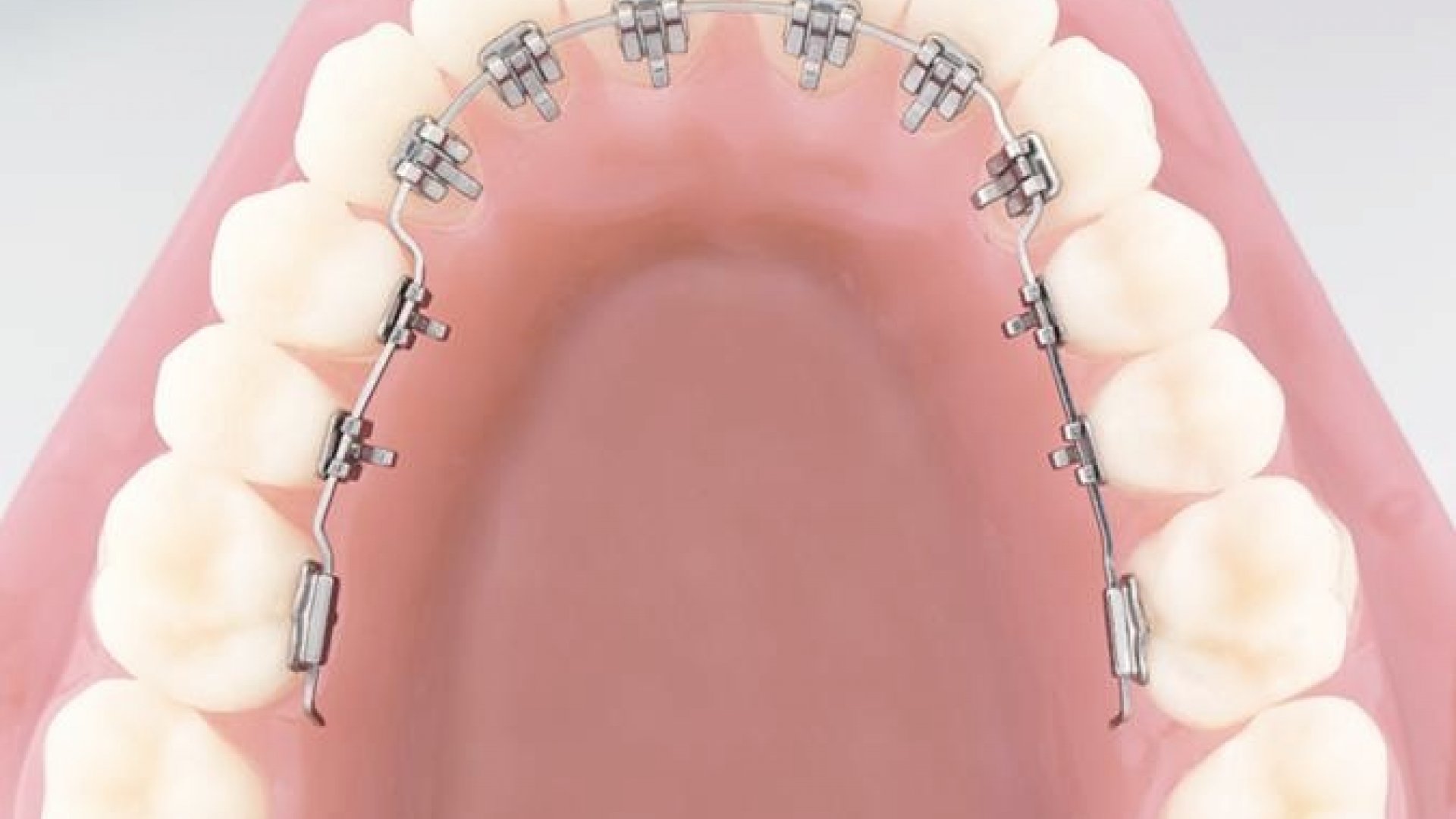 lingual-orthodontics-1.jpg