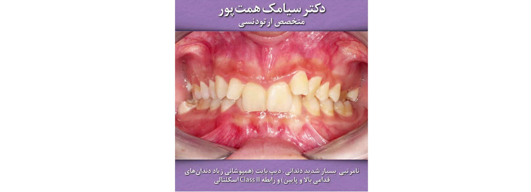 درمان ارتودنسی توسط دکتر سیامک همت پور