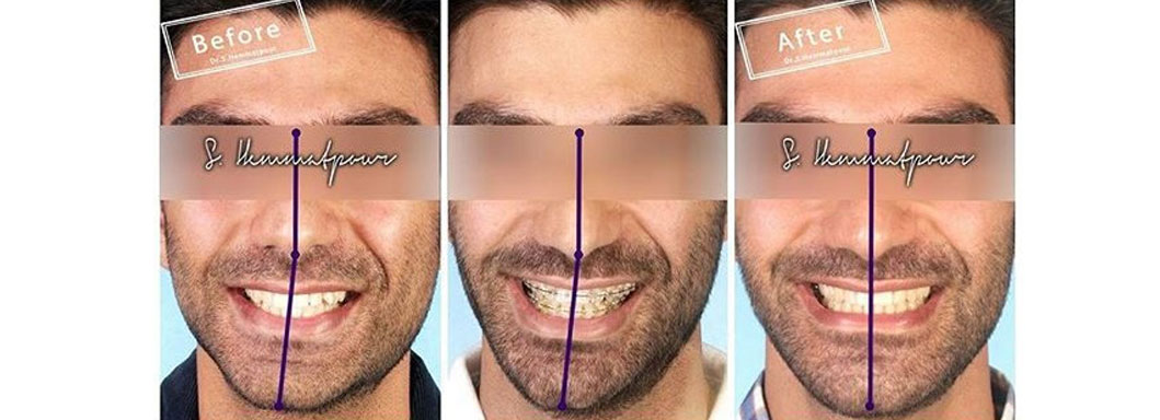 درمان ارتودنسی توسط دکتر سیامک همت پور