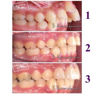 درمان ارتودنسی توسط دکتر سیامک همت پور