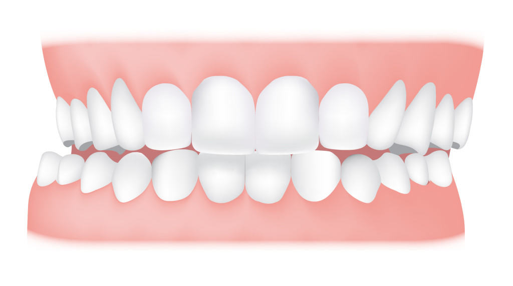 crossbite-1024x571