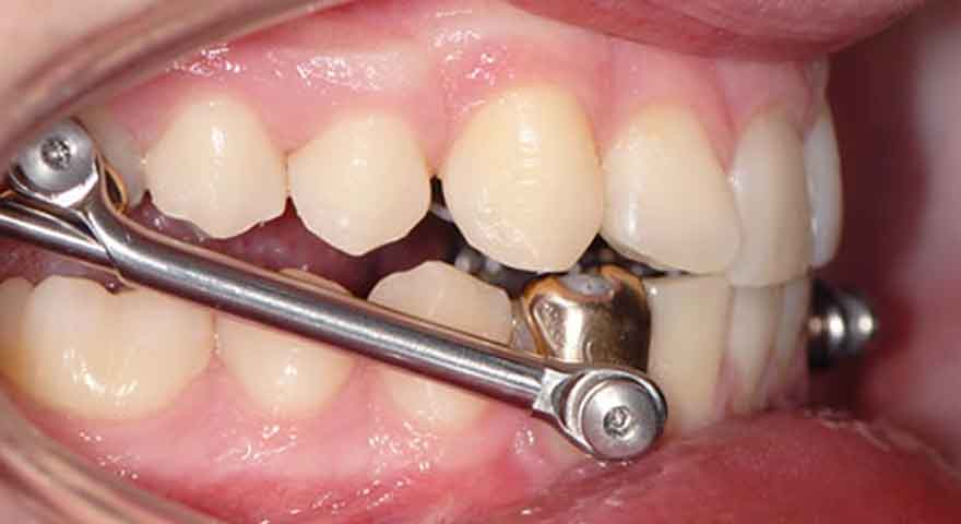 images_editorial_orthodontic-products_articles_legacy-images_online_article_002_200909_2009-09-16_013511_forestadent_easyfit
